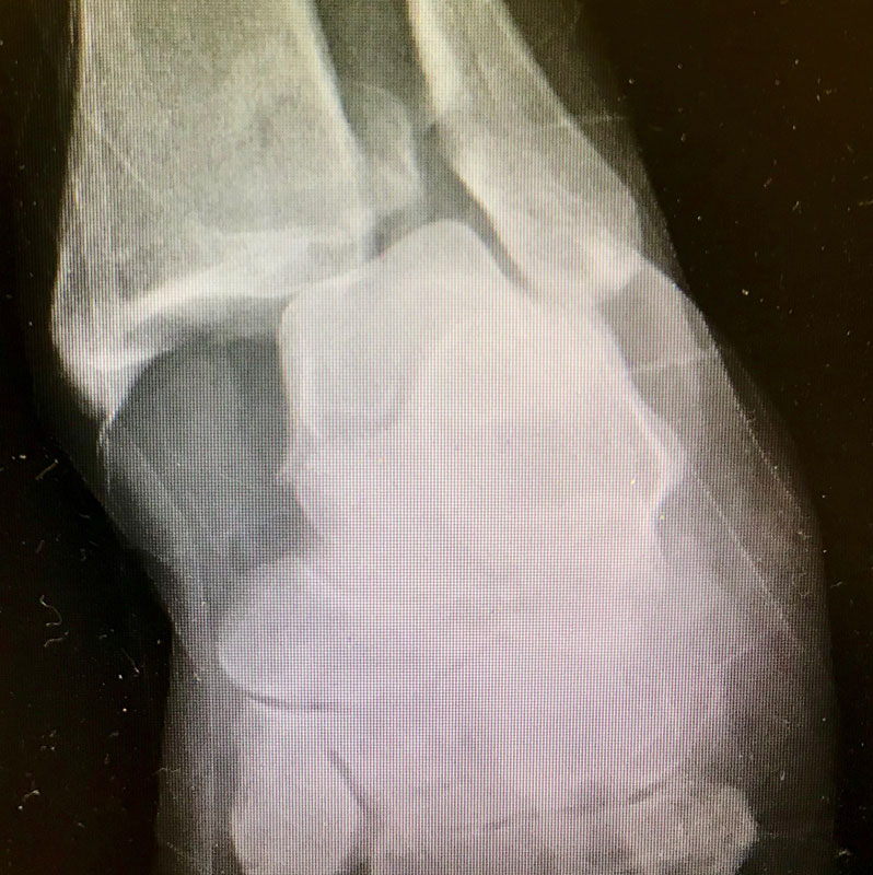 icd 10 code for right ankle syndesmotic injury