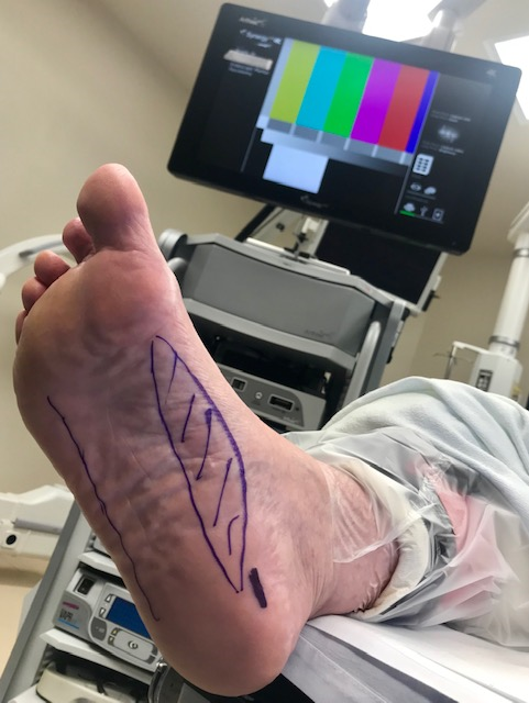 Chronic fasciitis clearance