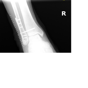 Broken Ankle Xray